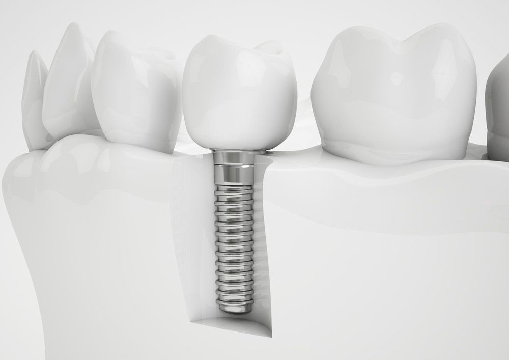 dental implant