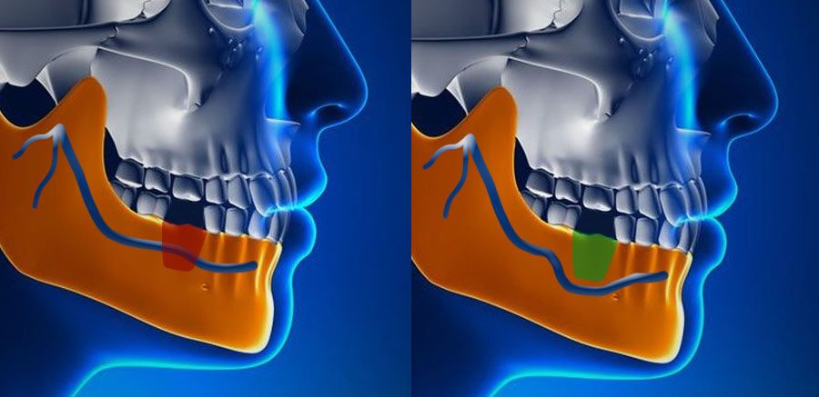 Illustration of projected implant placement with or without nerve repositioning surgery