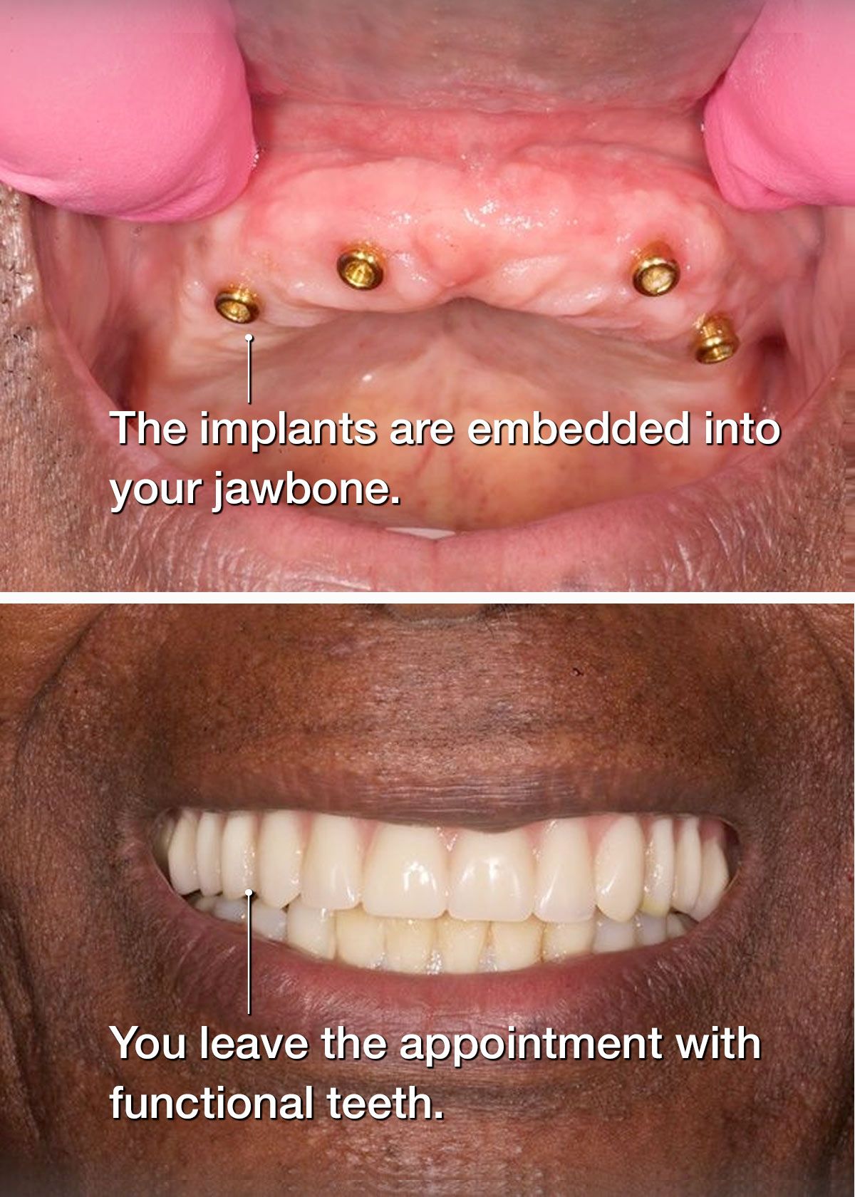 before and after of Teeth in a Day