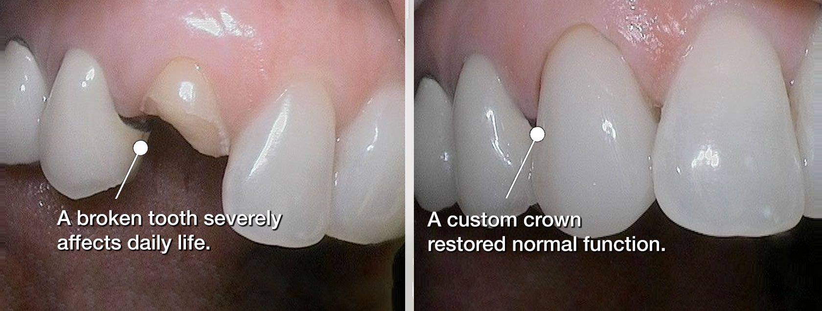 Before and after dental crown