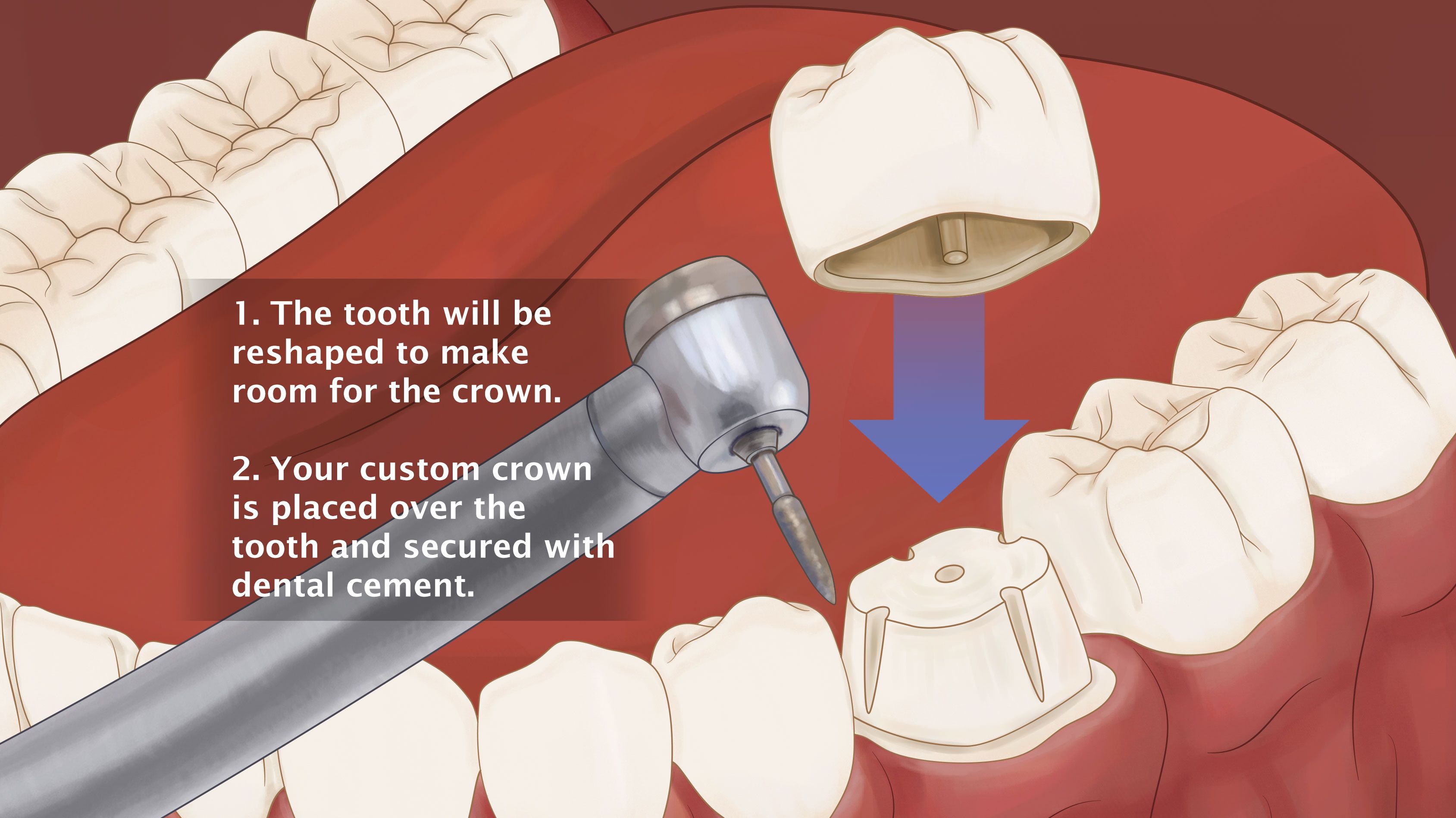 Illustration of crown placement